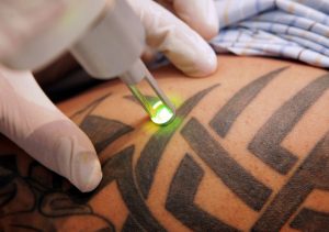 tatouage laser