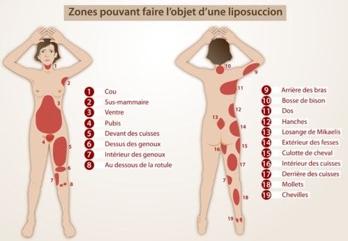 liposuccion-zones